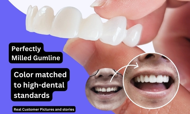 dintle veneers